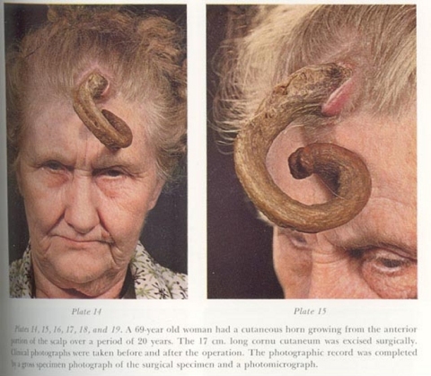 cutaneous horn